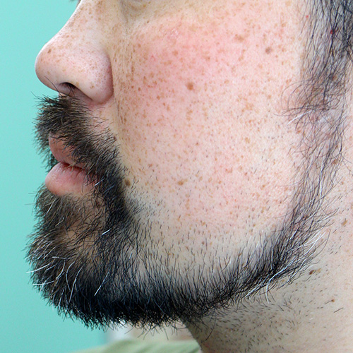 髭カット・ヒゲトリミング・ヒゲカットビフォー